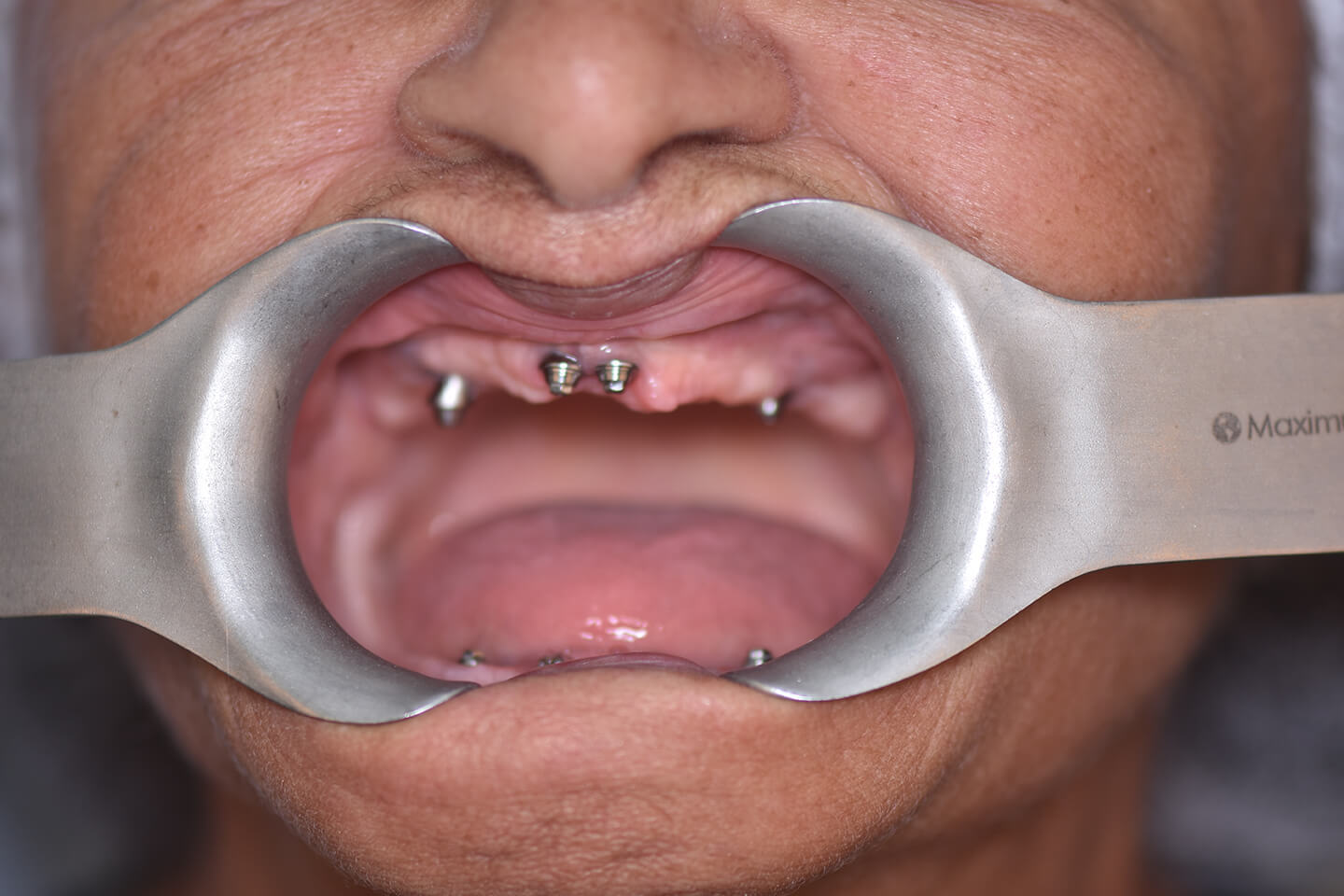 Caso Dr. Alfredo Lucas Neto, etapa 4: Etapa clínica, registro intraoral
