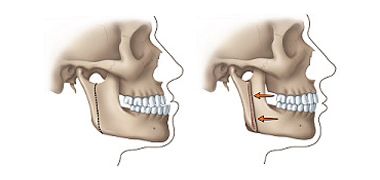 Cirurgia Ortognática