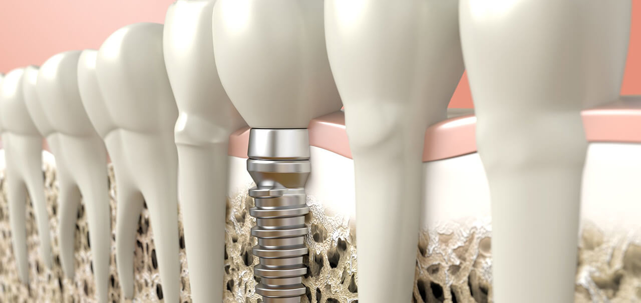 Implante dentário e aparelho ortodôntico combinam?